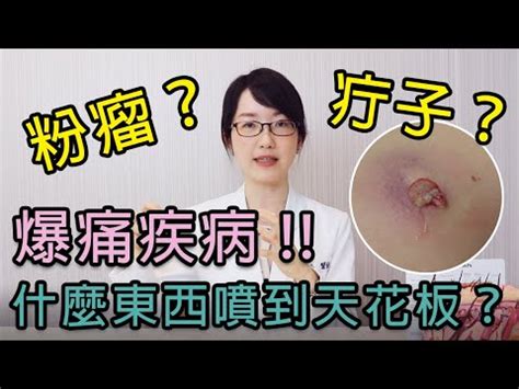 身體:tkqjl2dsi7y= 釘子|「長釘子」別亂擠！疔瘡是什麼？會自己好嗎？原因及治療方法一。